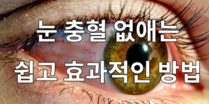 눈 충혈 없애는 쉽고 효과적인 방법