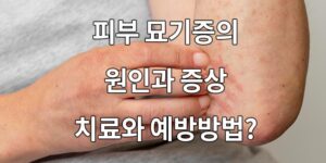 피부 묘기증의 원인과 증상, 치료와 예방방법은?